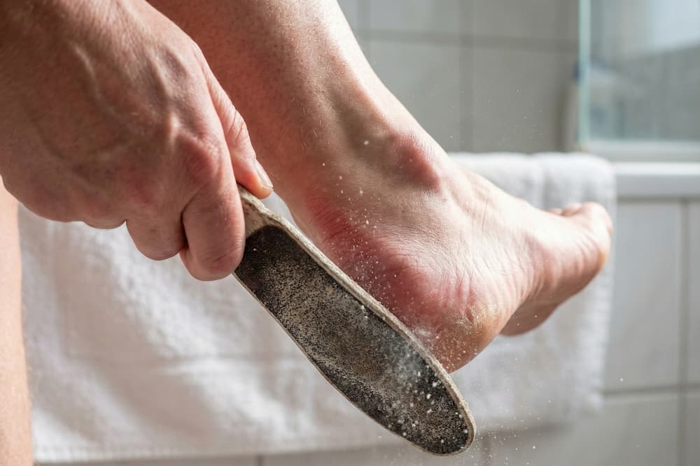 Et nærbillede af en hånd, der bruger en grov fodfil på en tør, sprukken hæl i et badeværelse. Filningen er tydeligt aggressiv, hvilket ses ved den store sky af hvide hudpartikler, der hvirvler op i luften, og det røde, irriterede område på huden, der indikerer overbehandling.