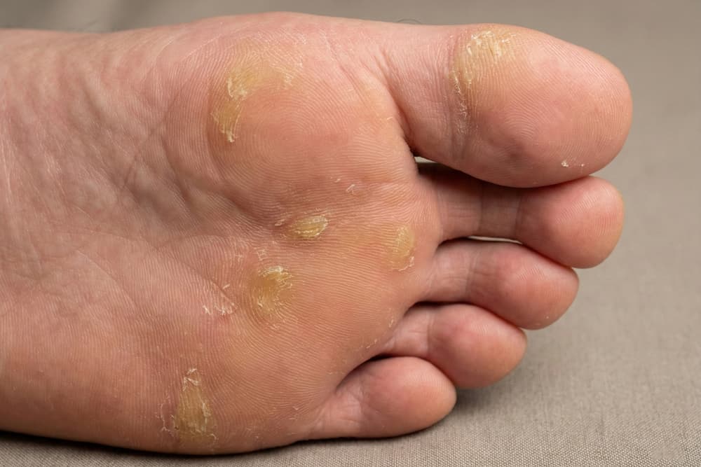 Et detaljeret nærbillede af en fodsål mod en neutral baggrund. Billedet viser tydelige plamager af gullig, hård hud (calluses) fordelt på trædepuden og under storetåen. Huden fremstår fortykket og ru med afskalninger, hvilket indikerer områder udsat for gentagen trykbelastning.