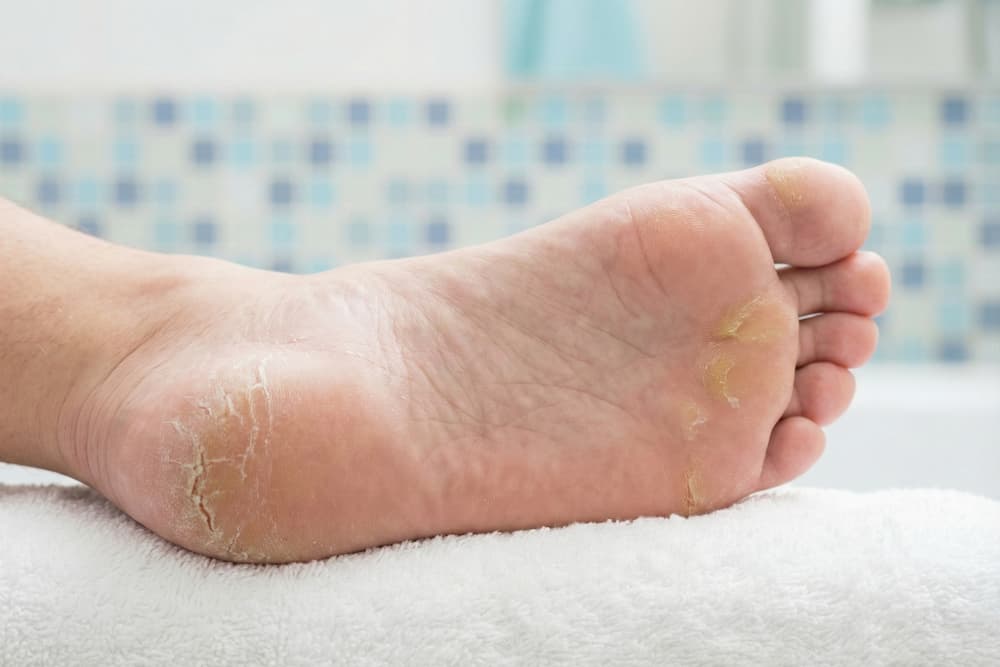 Et nærbillede af en fodsål, der hviler på et blødt, hvidt håndklæde foran en sløret baggrund af blå fliser. Huden på hælen fremstår ekstremt tør med synlige krakeleringer og revner, mens forfoden og storetåen viser områder med gullig, hård hud.