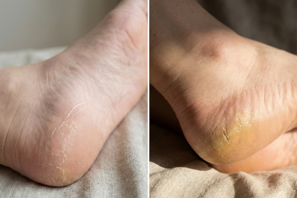 Et detaljeret sammenligningsbillede af hudens tilstand på hælen. Til venstre ses huden tør og hvidligt skællende med en krakeleret overflade, mens billedet til højre viser en kraftigere ophobning af gullig hård hud med dybe revner, hvilket illustrerer de typer af skadet hud, behandlingen retter sig imod.