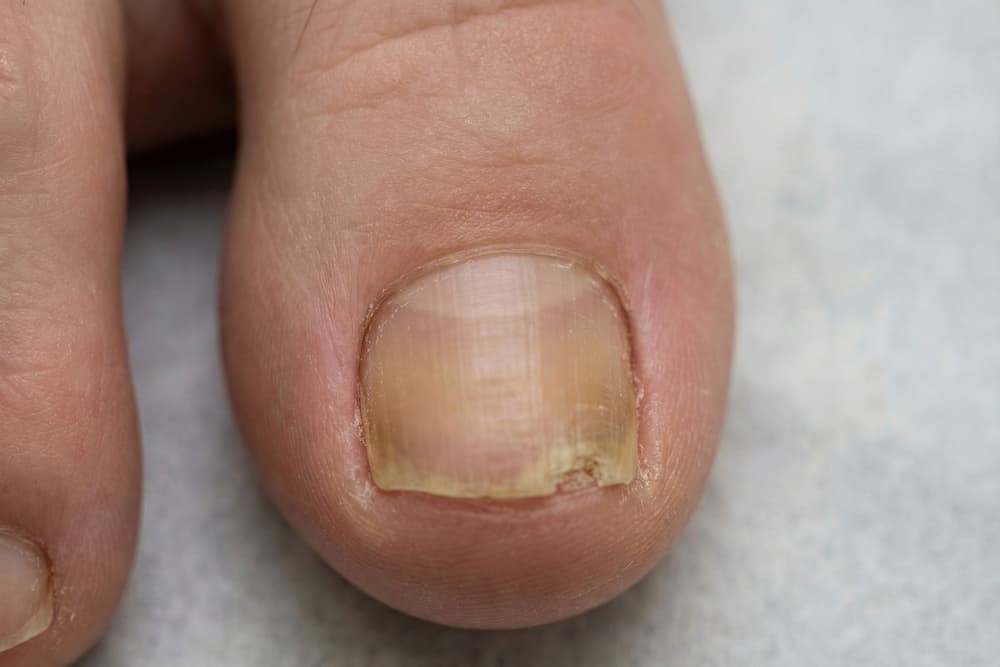 Et makro-nærbillede af en storetå, der viser tydelige tegn på neglesvamp. Neglepladen fremstår fortykket med en gullig-brun misfarvning og lodrette riller, mens den yderste kant er skør og smuldrende.