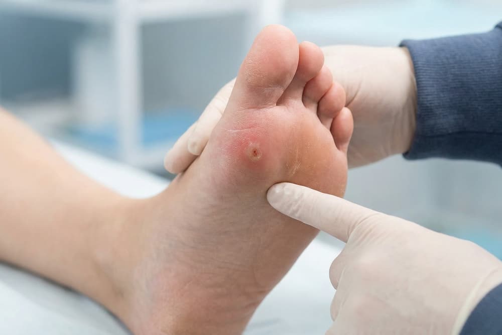 Et nærbillede af en fod med et hævet, rødt, cirkulært sår eller en blister på huden nær tæernes rode, hvilket muligvis indikerer en hudinfektion eller læsion. Baggrunden er blå med hvide genstande ude af fokus.