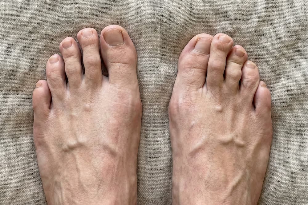 Et par fødder set ovenfra; venstre fod ser normal ud, mens højre fod har en synlig knyst, der får storetåen til at vinkle indad. Baggrunden er ensfarvet og neutral.